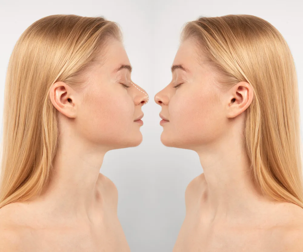 Rhinoplasty Recovery Timeline