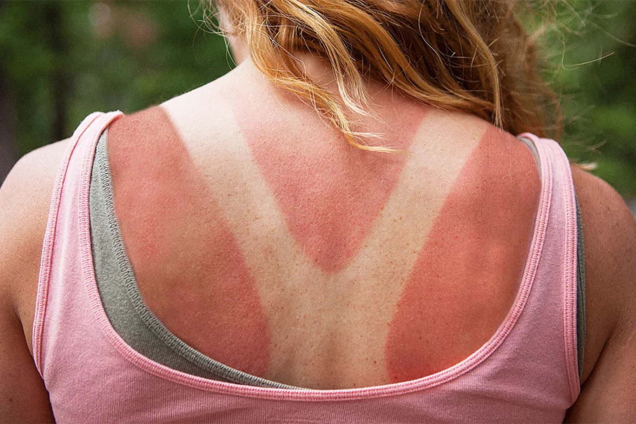 gunes-yaralari-blog-1 - KTM Medical Center