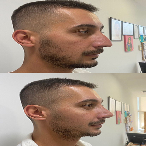 Saç Ekimi Öncesi ve Sonrası