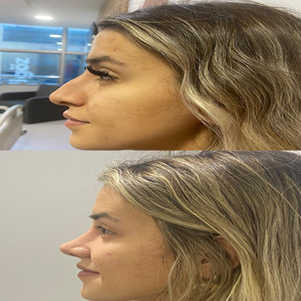 Saç Ekimi Öncesi ve Sonrası